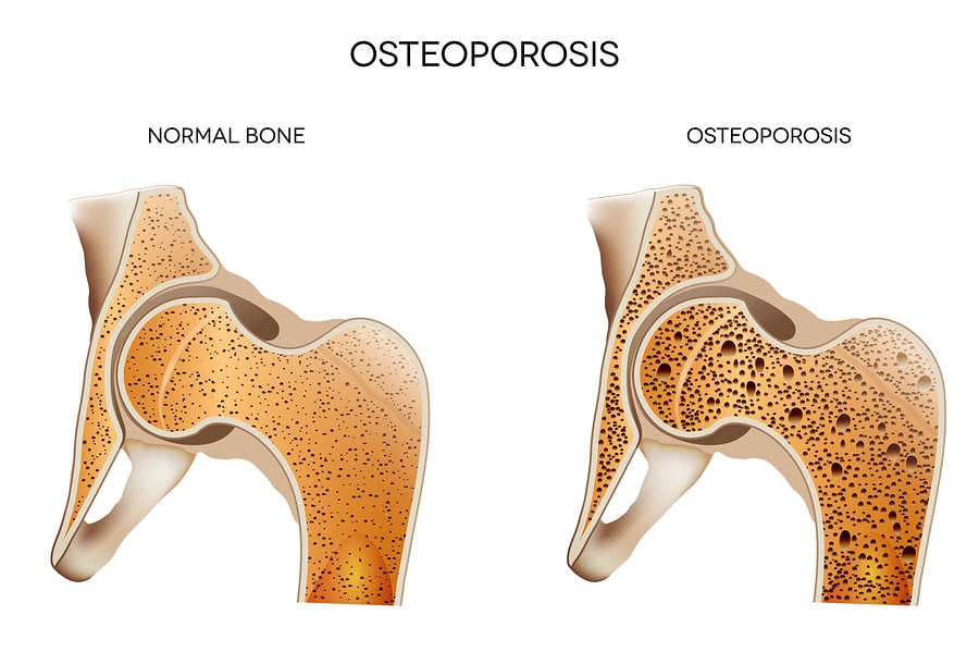 Home Care Emporium PA - Understanding Osteoporosis: Stages and Risk Factors